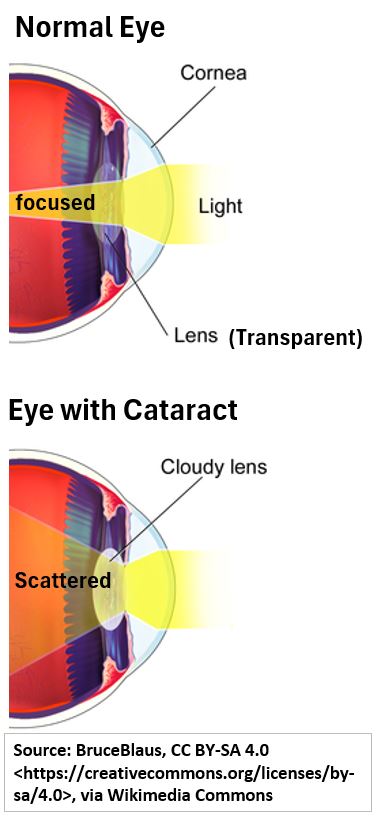 Side View Normal Eye vs Eye With Cataract